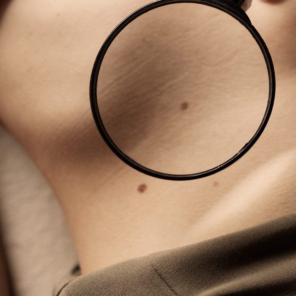 Unauffälliges Muttermal am Bauch wird mit einer Lupe untersucht